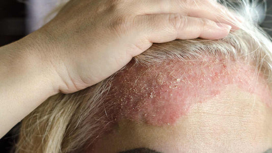 How Skin is Impacted During the Winter Months