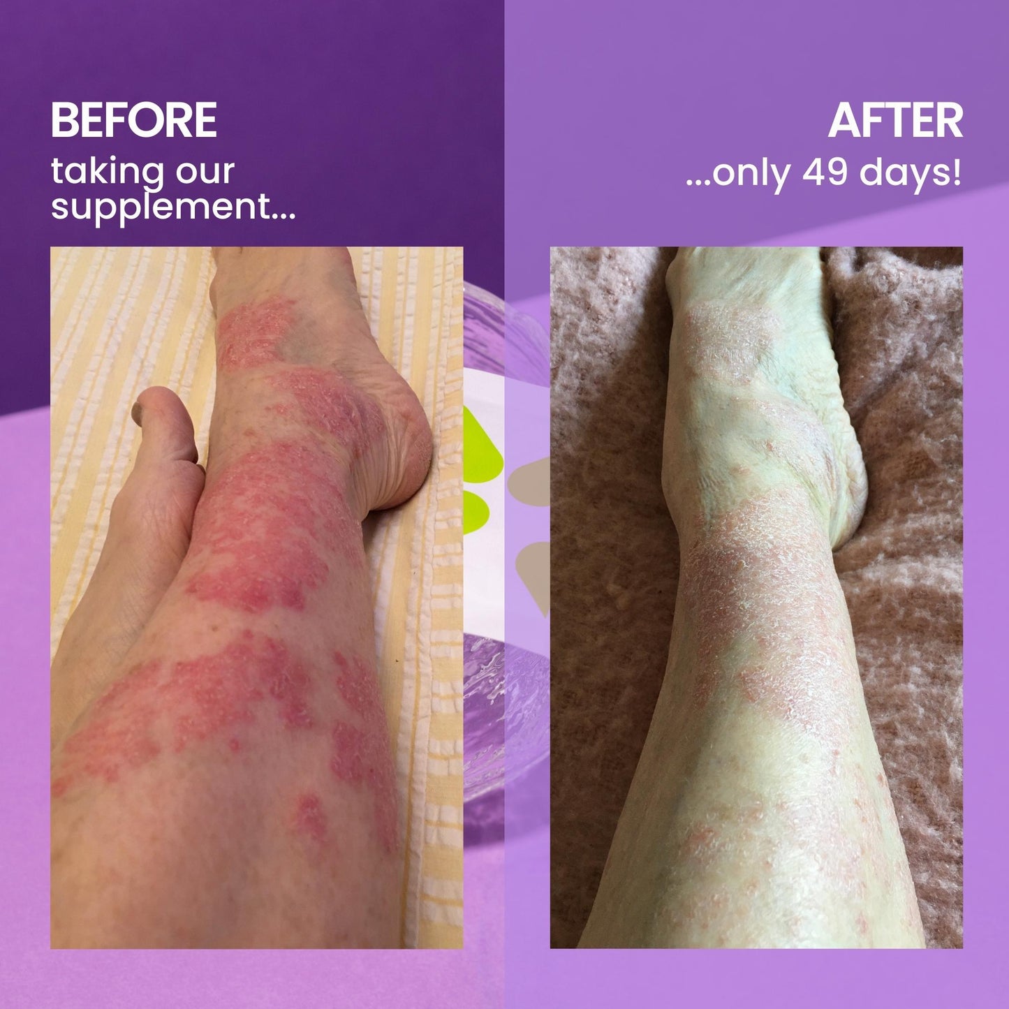 AxisBiotix Skin Calm Psoriasis Support