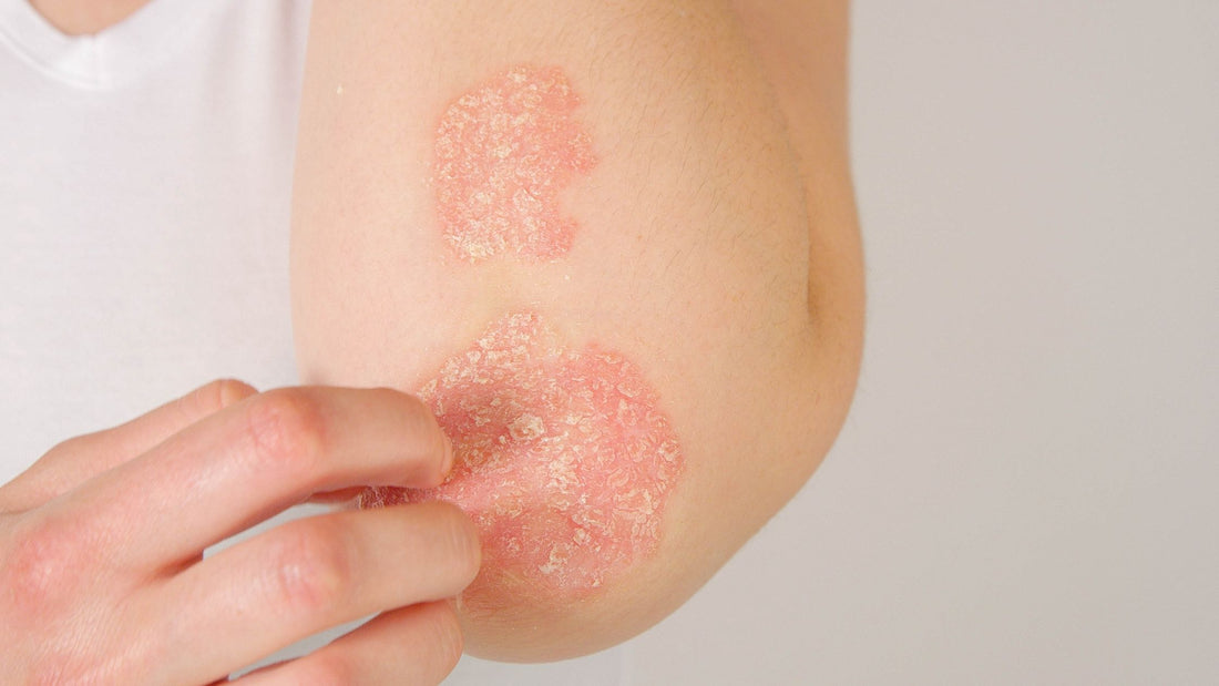 5 Different Types of Psoriasis