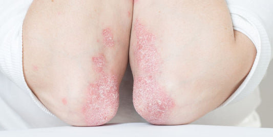 psoriasis on elbows and backs of arms