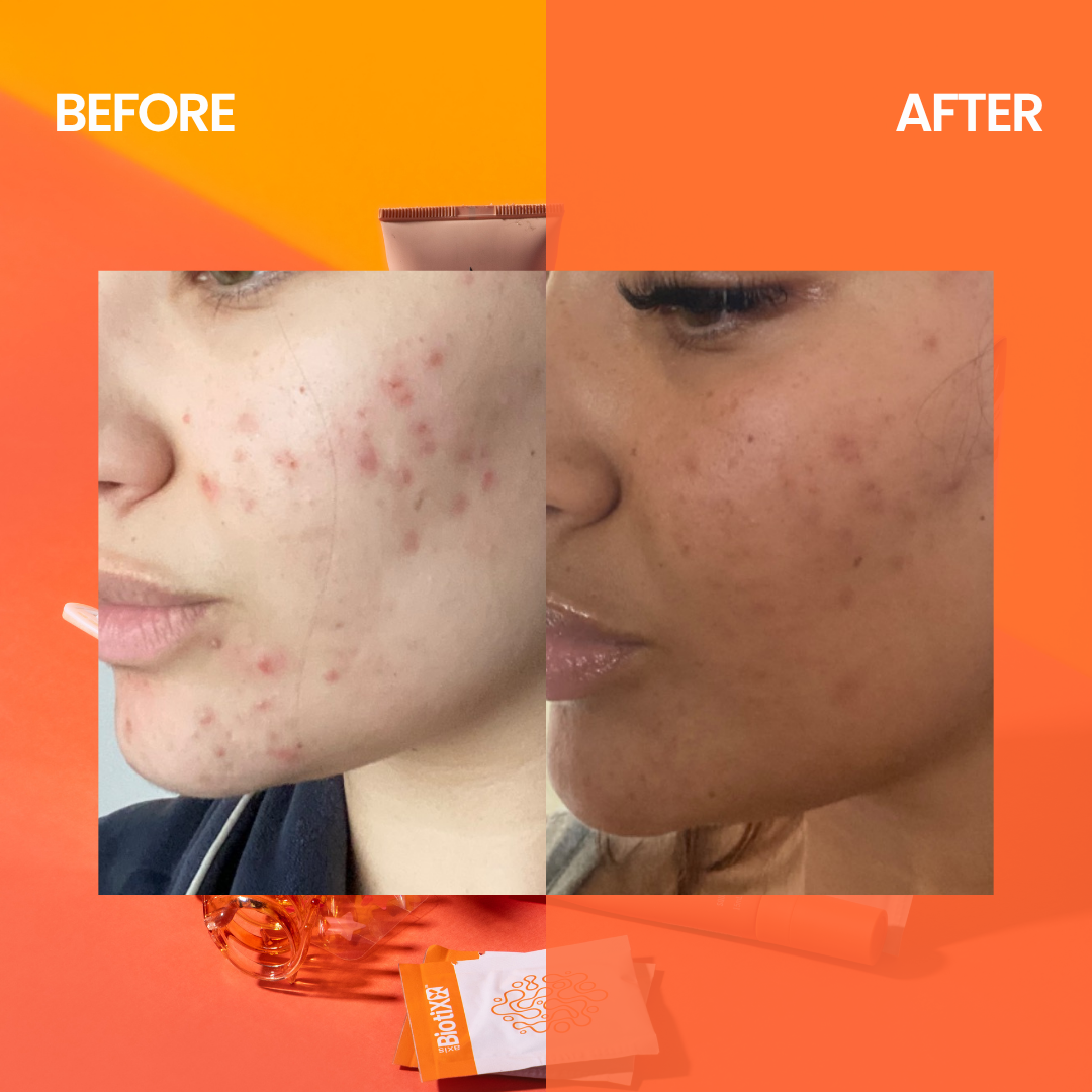 AxisBiotix Skin Clear Acne Support